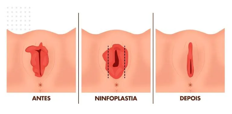 Cirurgia Íntima Feminina: Entenda o Que é a Ninfoplastia e Quando Optar pelo Procedimento