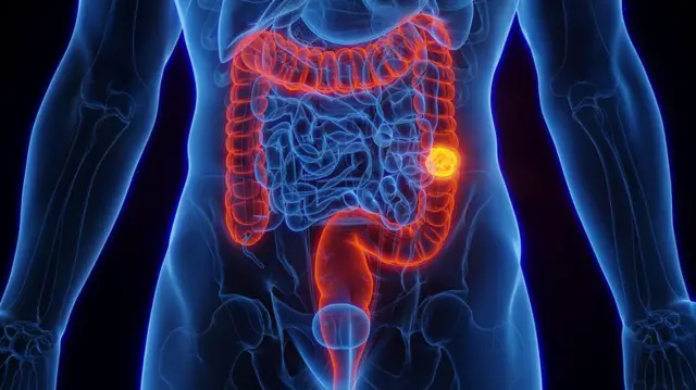 Chico Pinheiro: Especialista esclarece perigos, métodos de prevenção e sintomas do câncer intestinal
