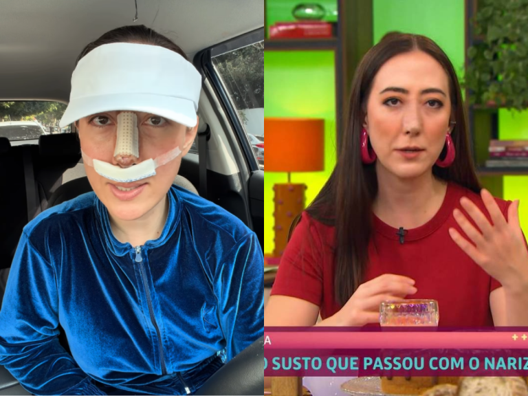 Jornalista do “Mais Você” compartilha superação após incidente com PMMA no nariz