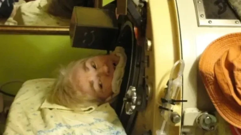 Falece aos 78 anos a última paciente que utilizava o pulmão de aço nos Estados Unidos