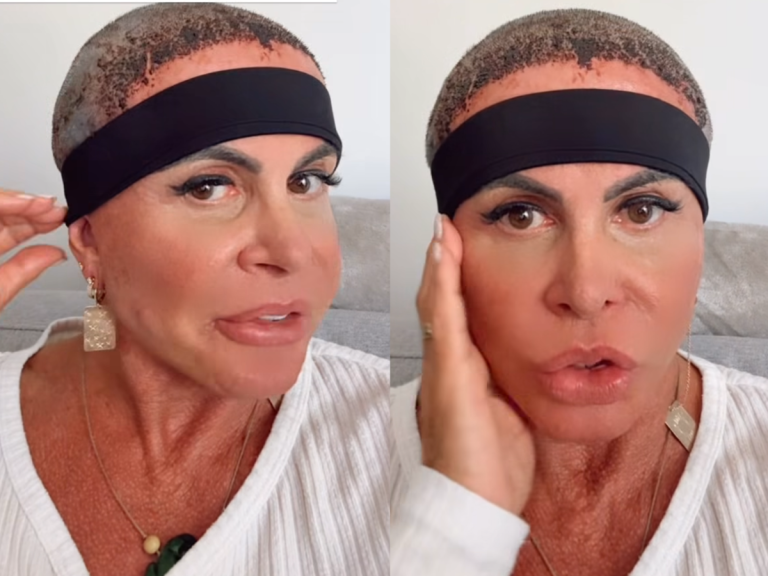 Gretchen compartilha novidades sobre sua recuperação após o transplante capilar